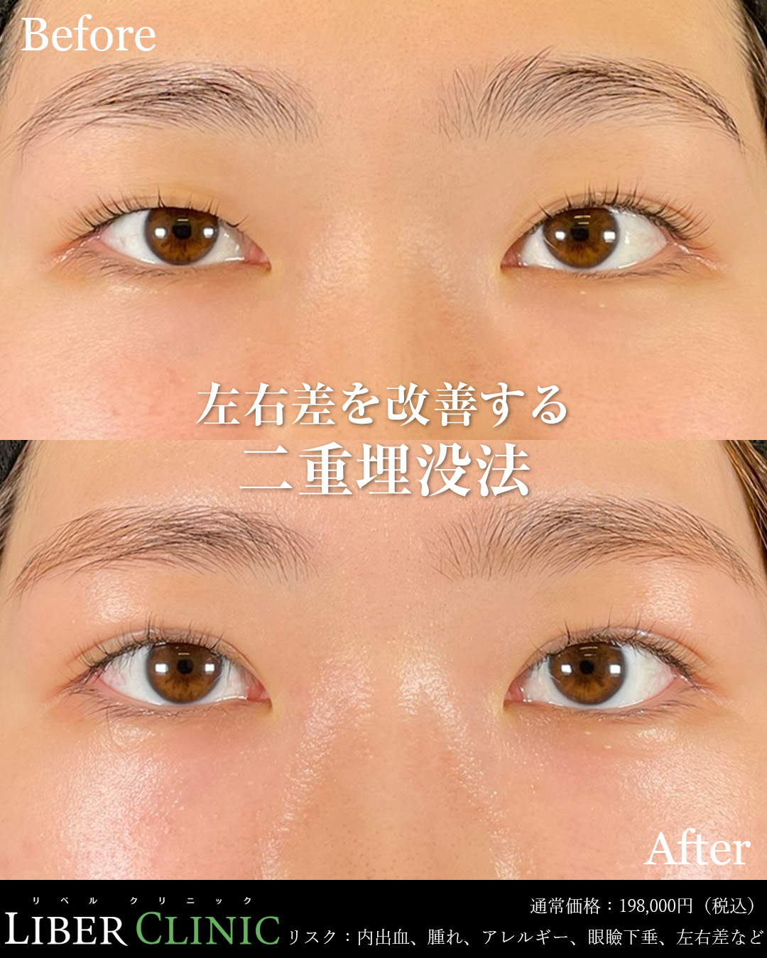 左右差を改善する二重埋没法