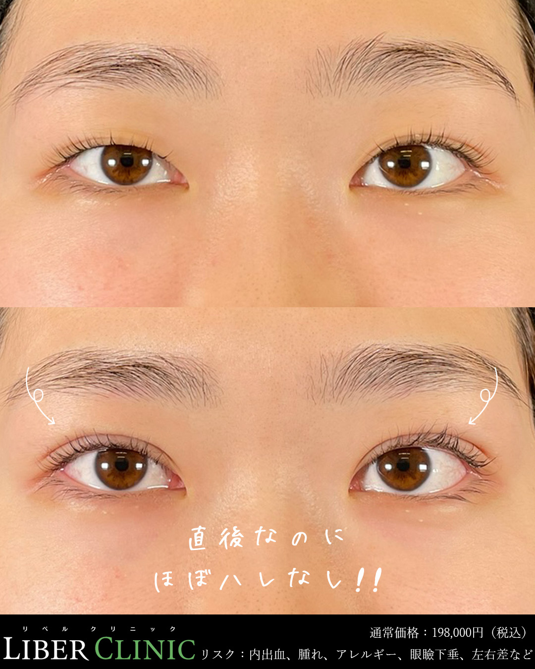 直後なのにほぼハレなし！