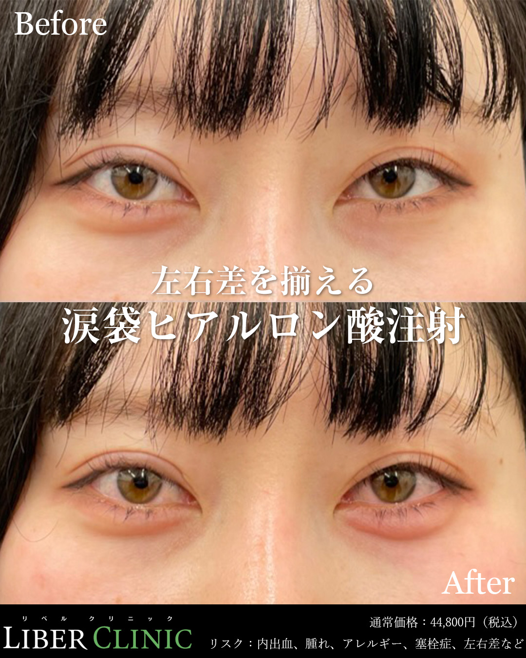 左右差を整える涙袋ヒアルロン酸注射