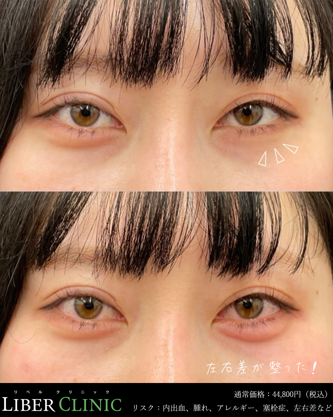 涙袋の左右差が整った！
