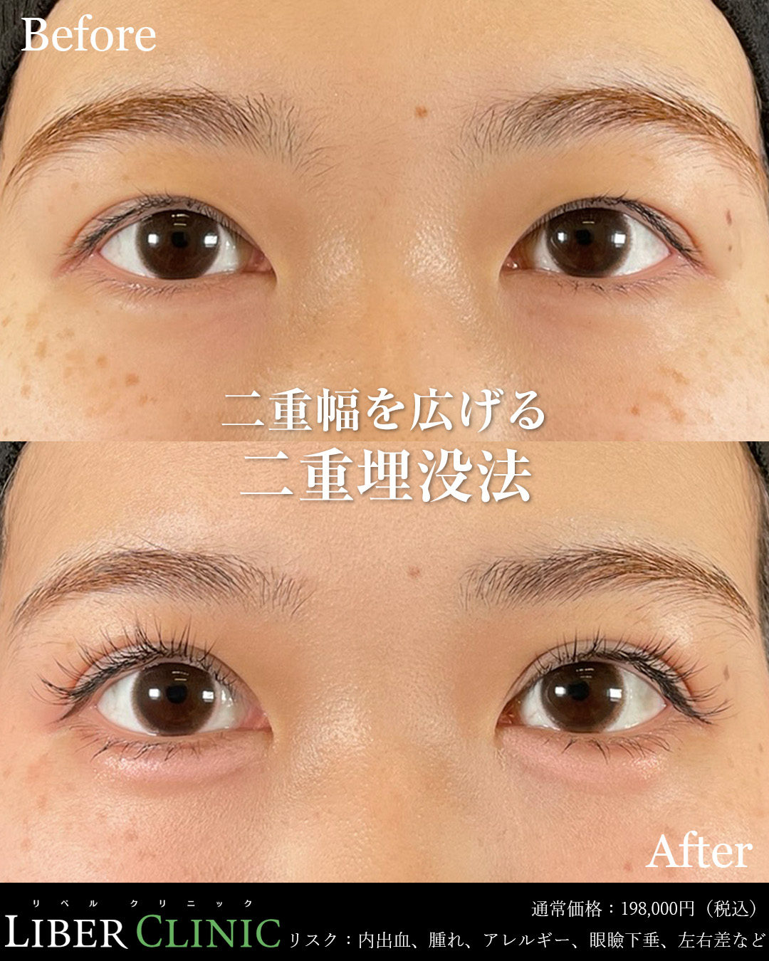 二重幅を広げる二重埋没法