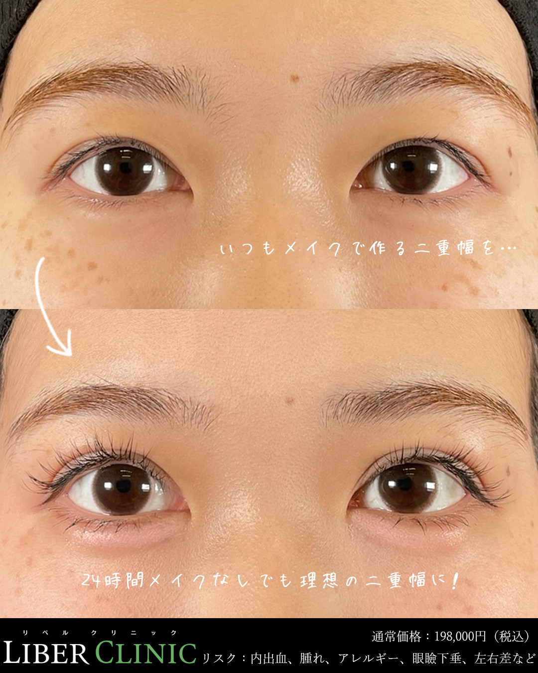 24時間メイクなしでも理想の二重幅に！