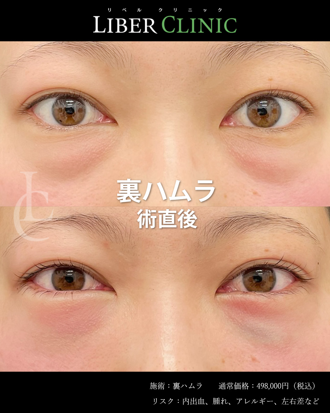 手術前と術直後