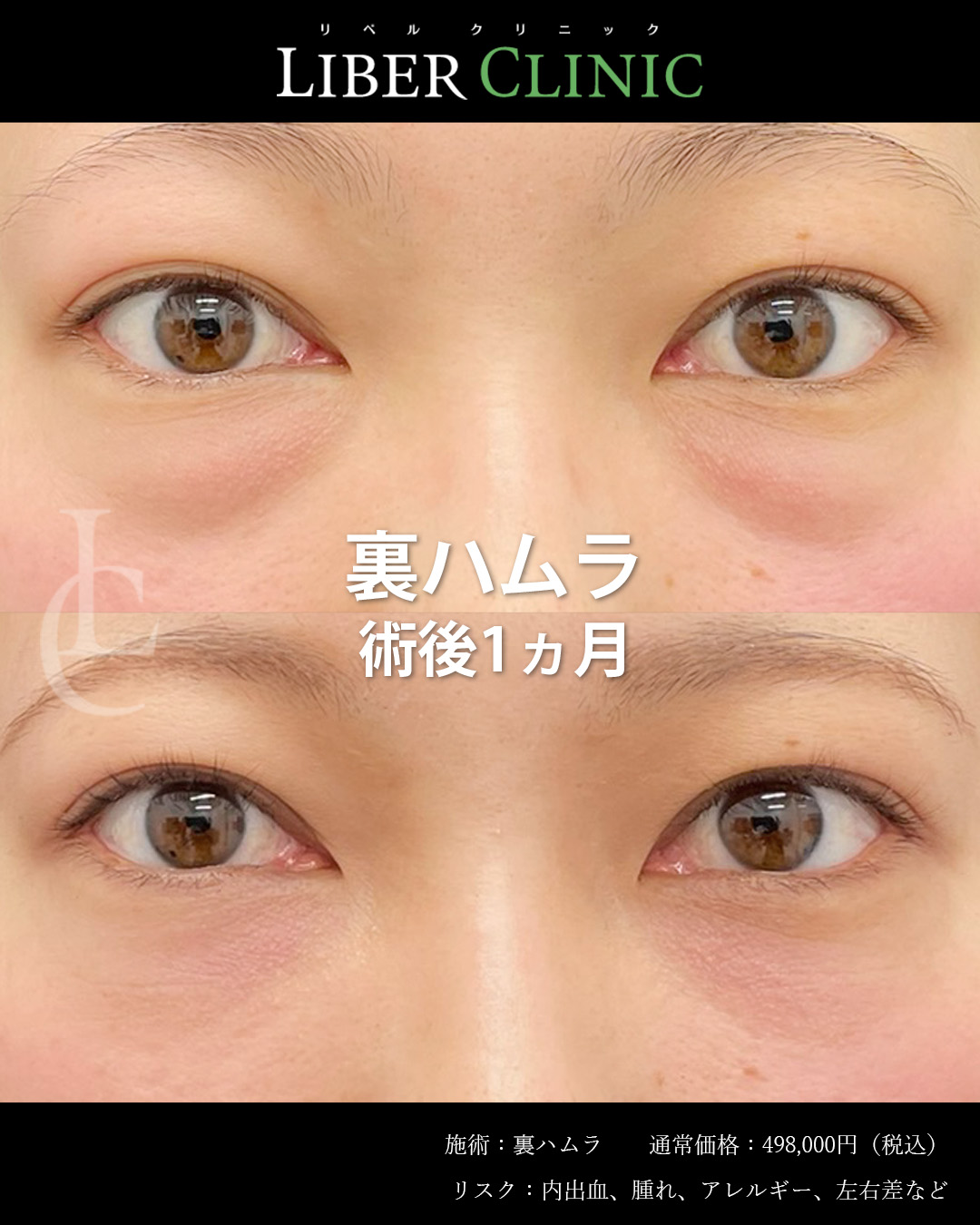 手術前と術後1ヵ月