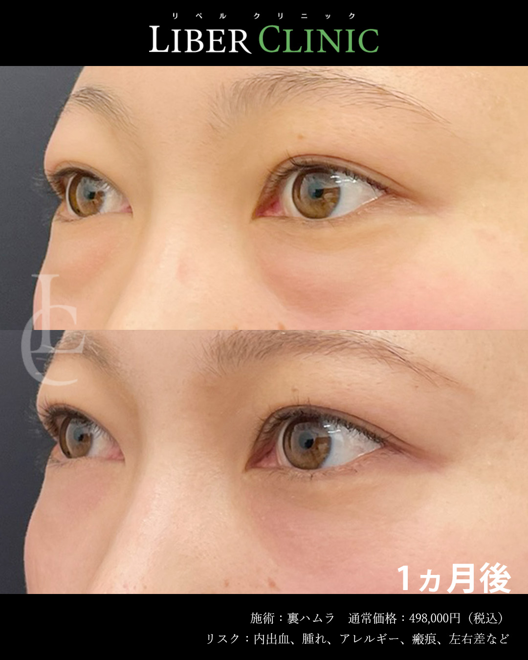 手術前と術後1ヵ月