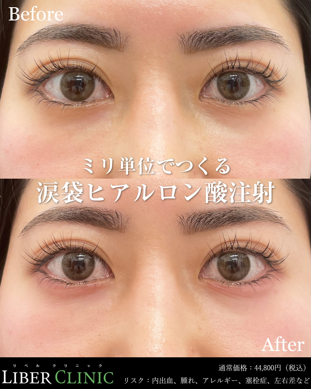 ミリ単位でつくる涙袋