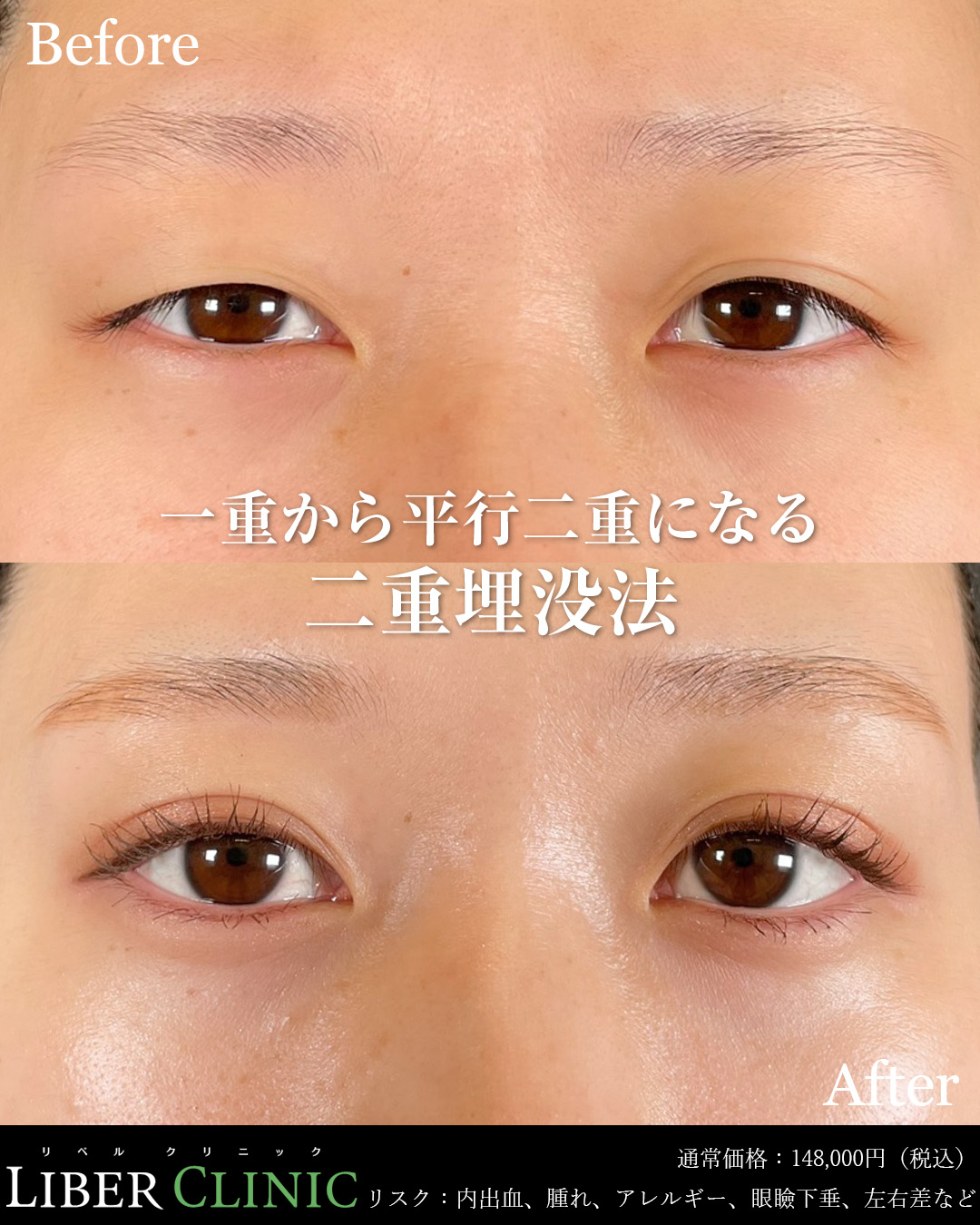 一重から平行二重になる二重埋没法