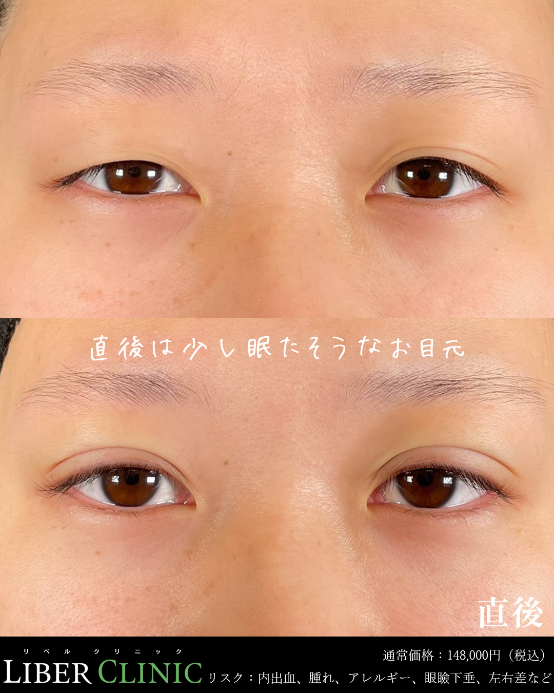 術直後は少し眠たそうなお目元