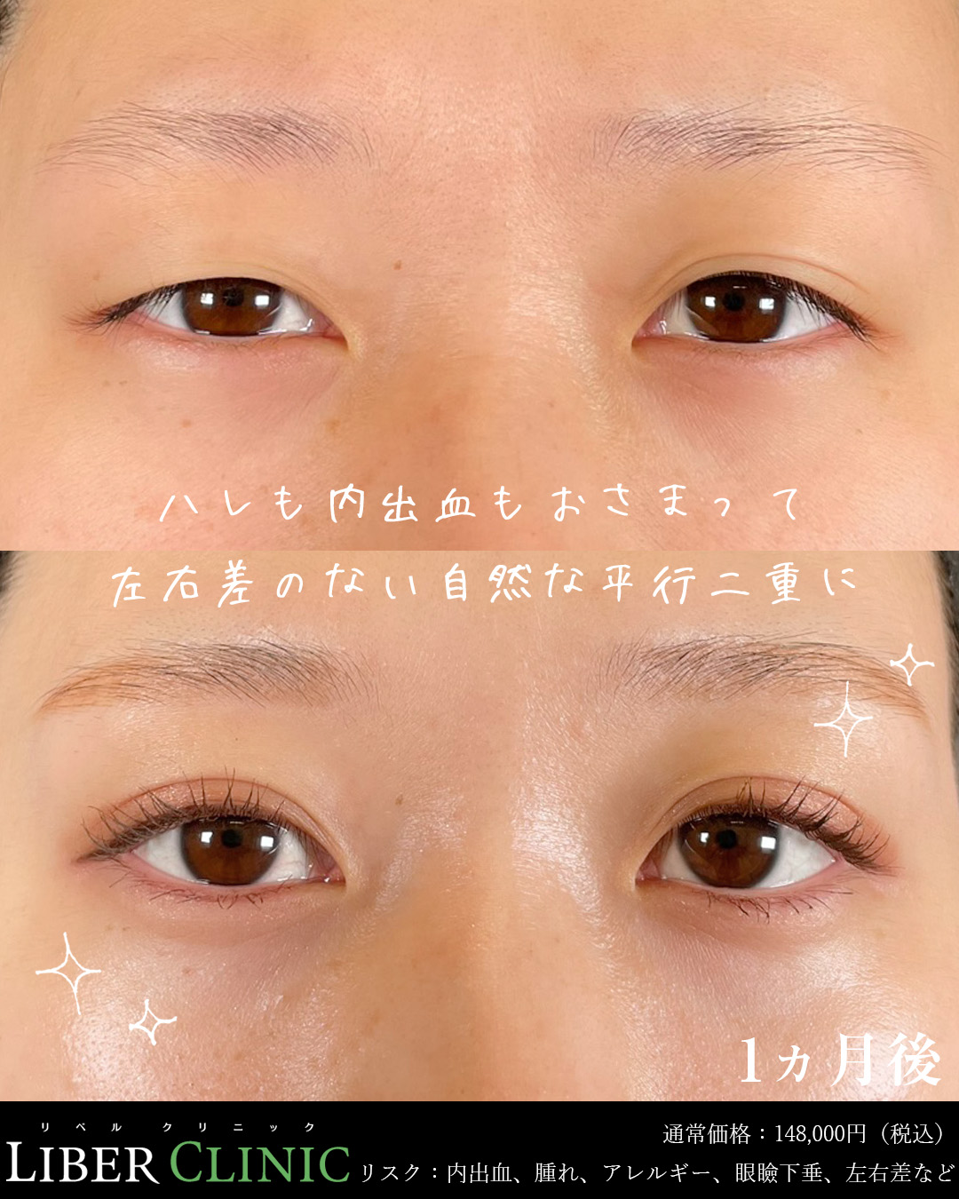 ハレも内出血もおさまって、左右差のない自然な平行二重に