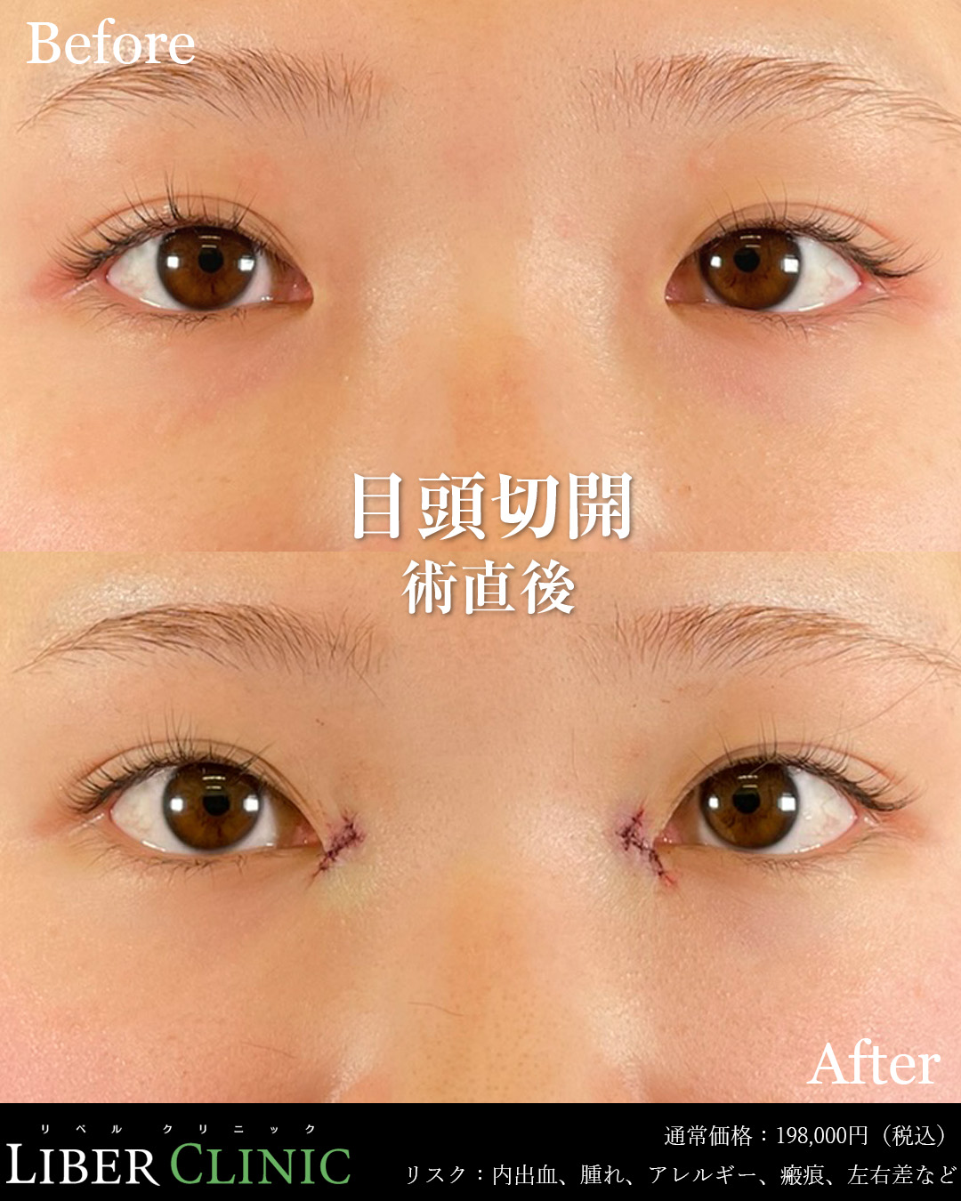手術前と術直後
