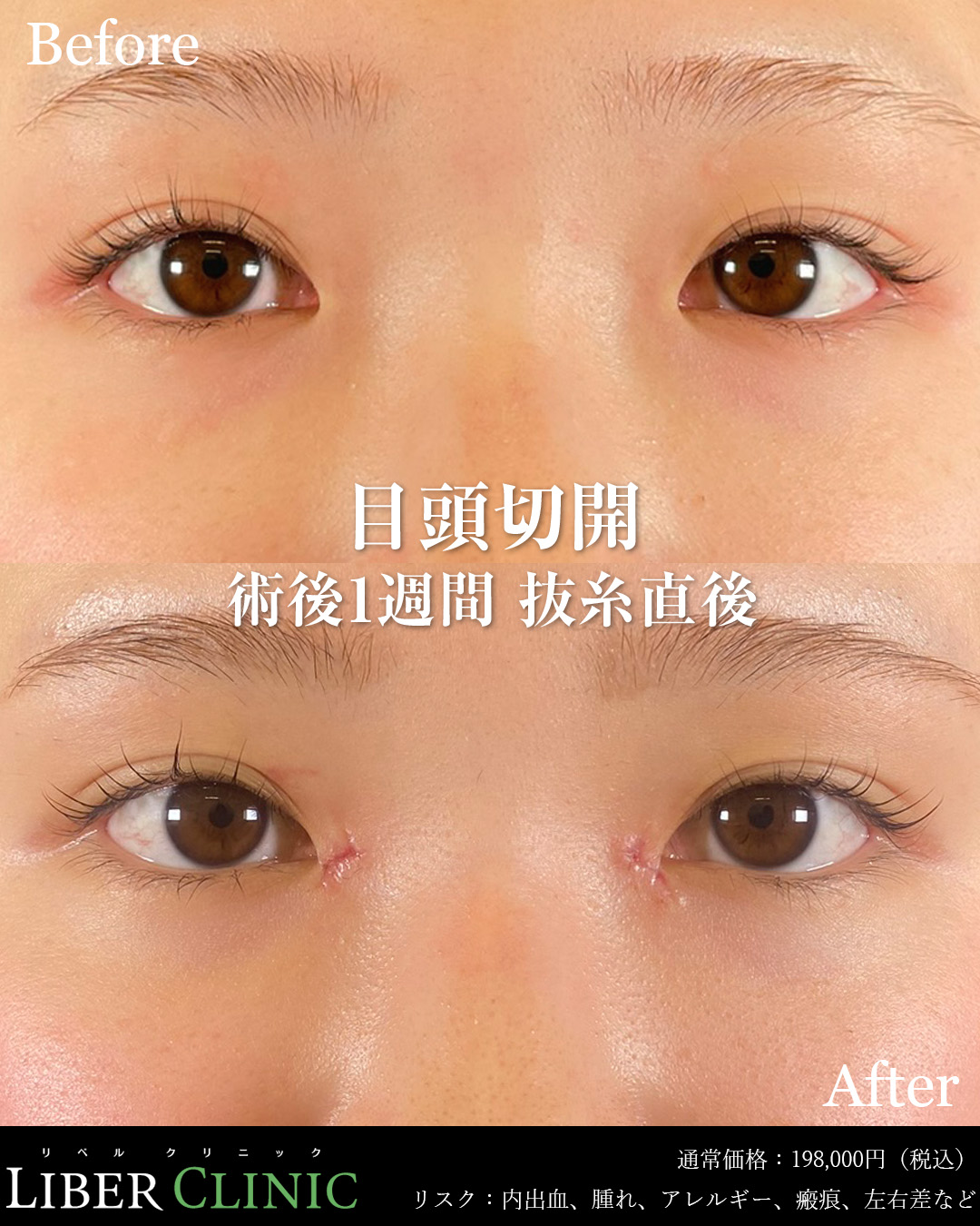 手術前と術後1週間（抜糸直後）