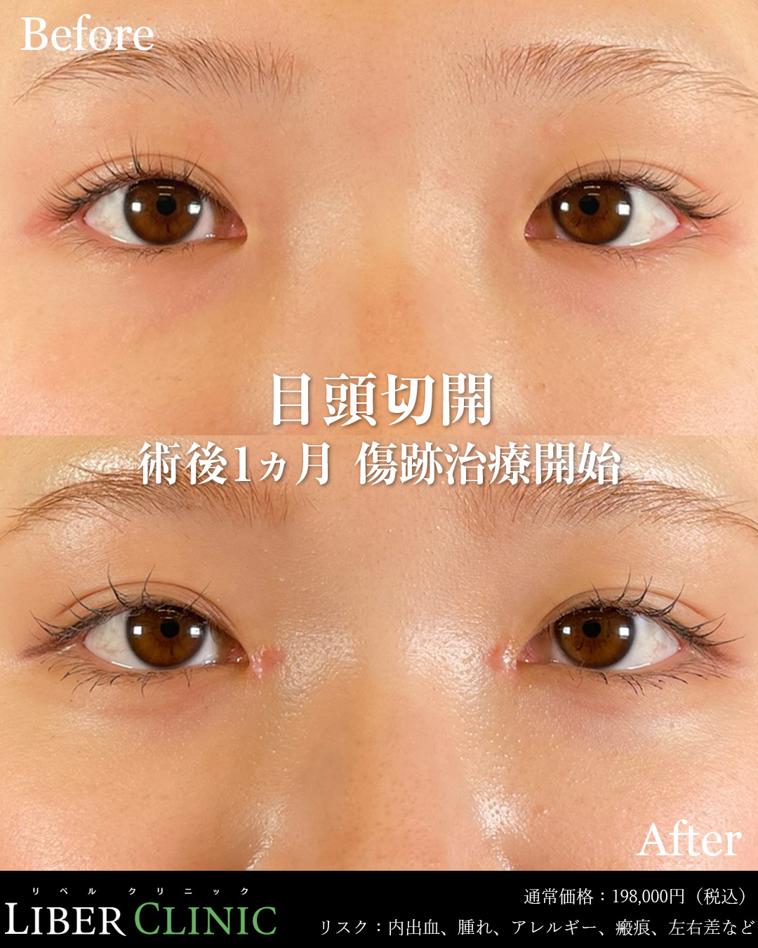 手術前と術後1ヵ月（傷跡治療開始）