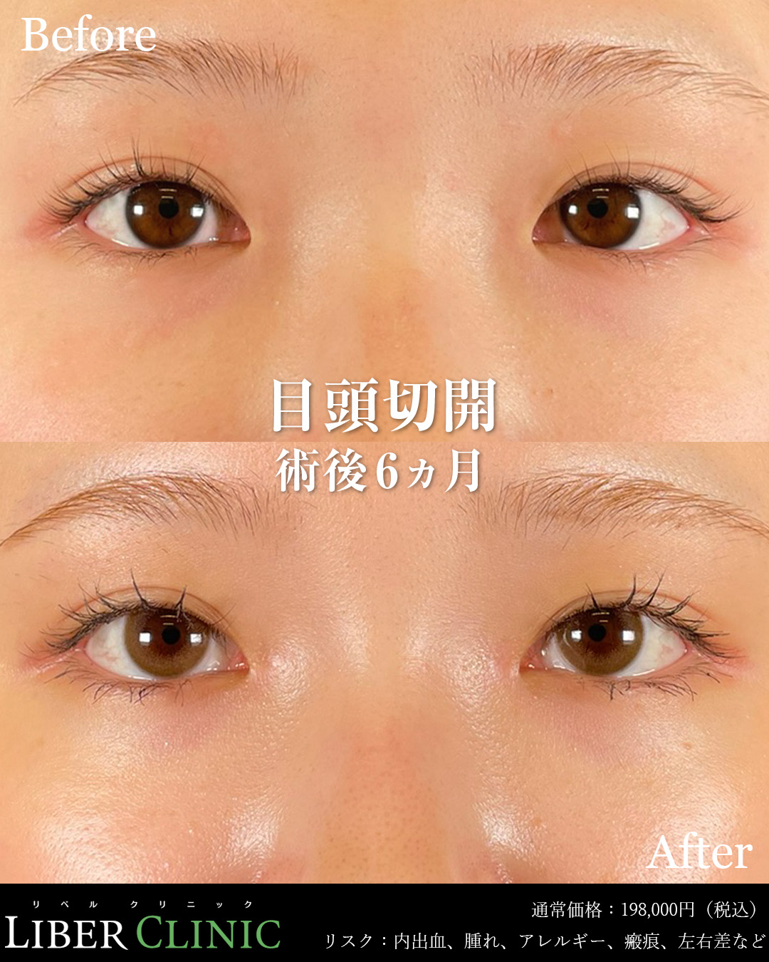 手術前と術後6ヵ月