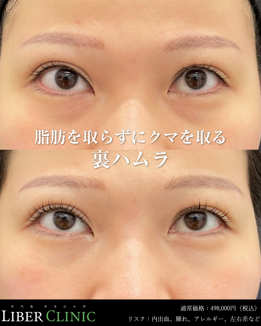 脂肪を取らずにクマを取る裏ハムラ
