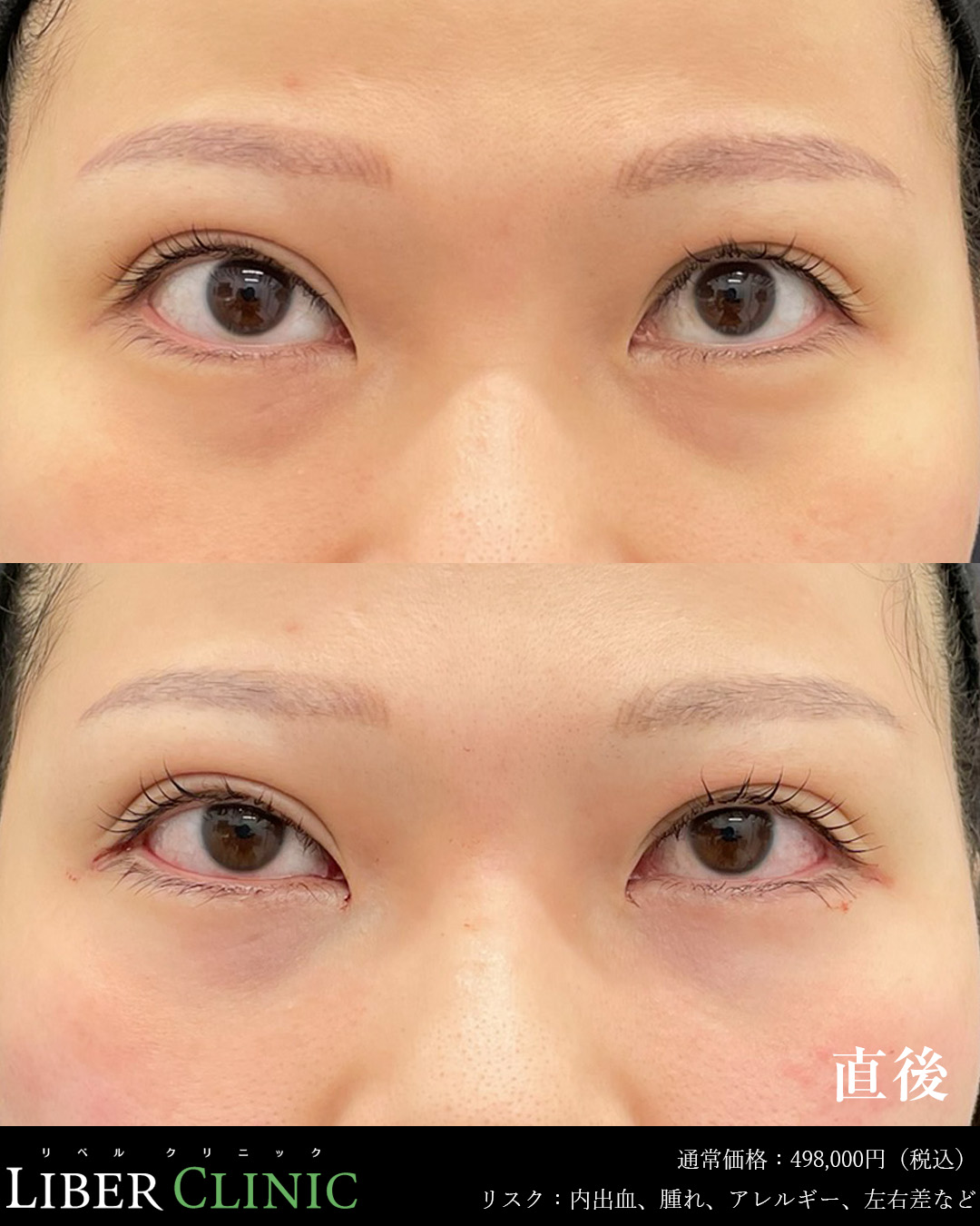 手術前と術直後