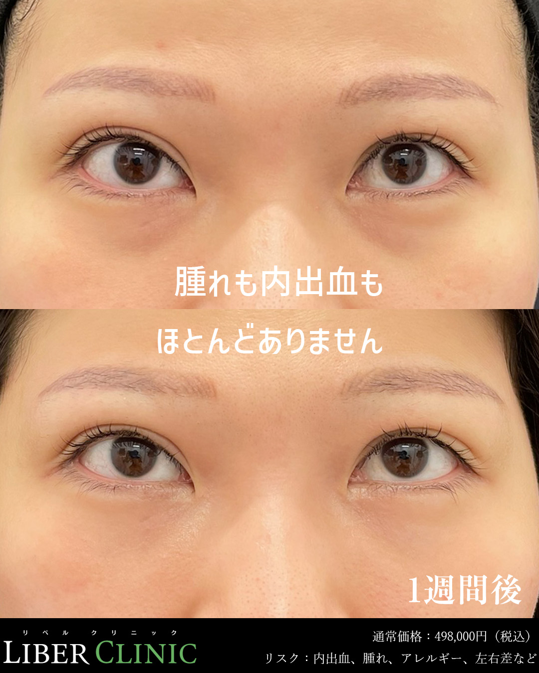 腫れも内出血もほとんどありません