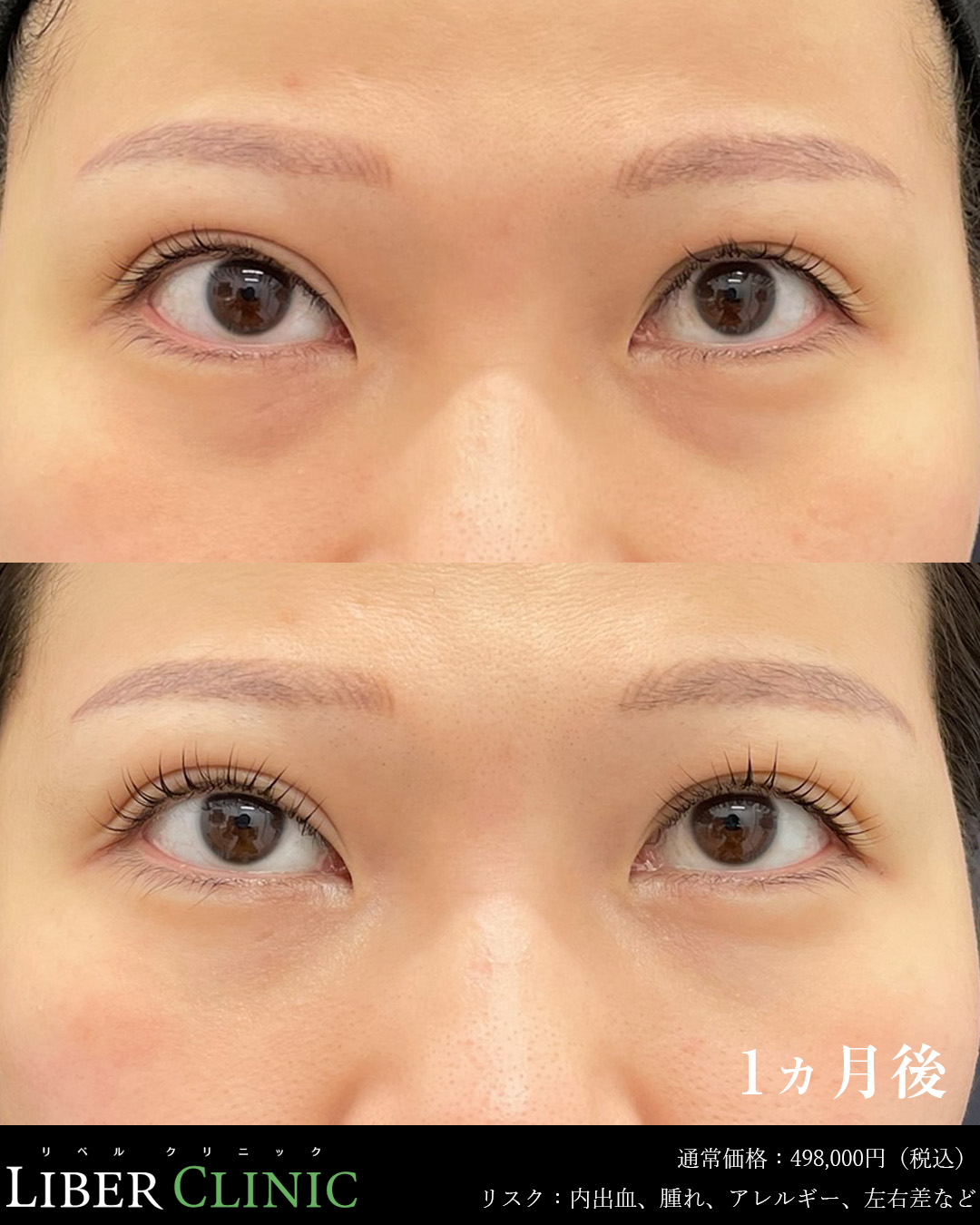 手術前と術後1ヵ月