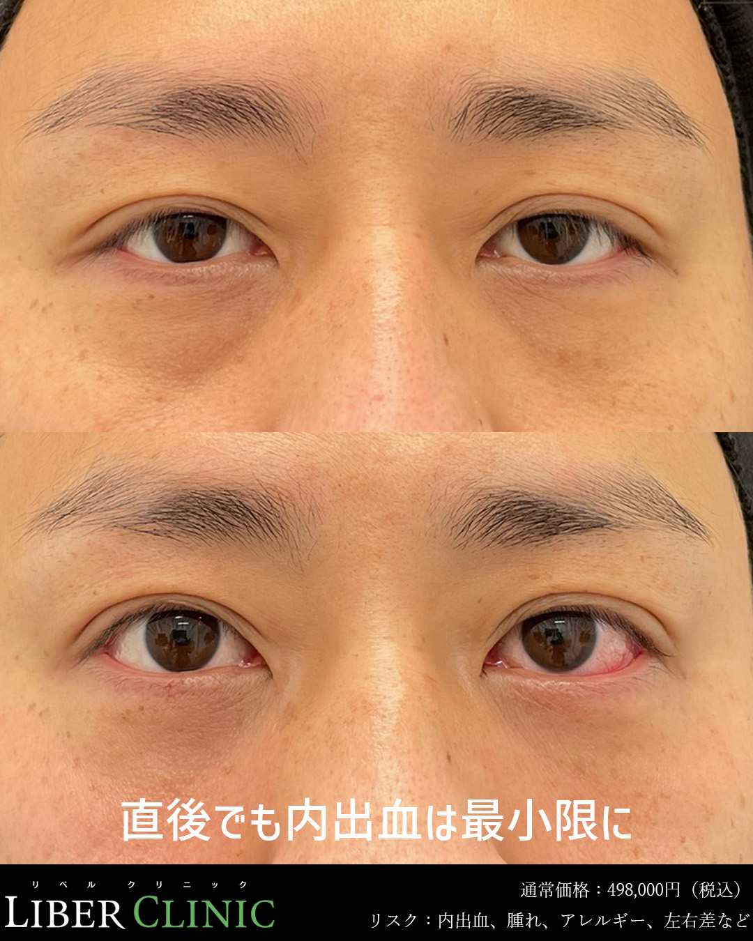 直後でも内出血は最小限に