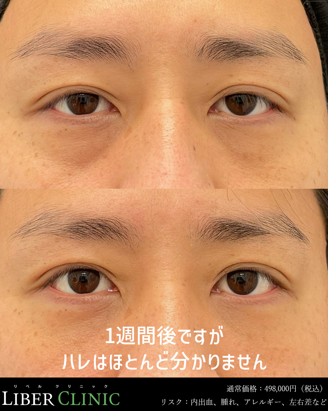 1週間後ですがハレはほとんど分かりません