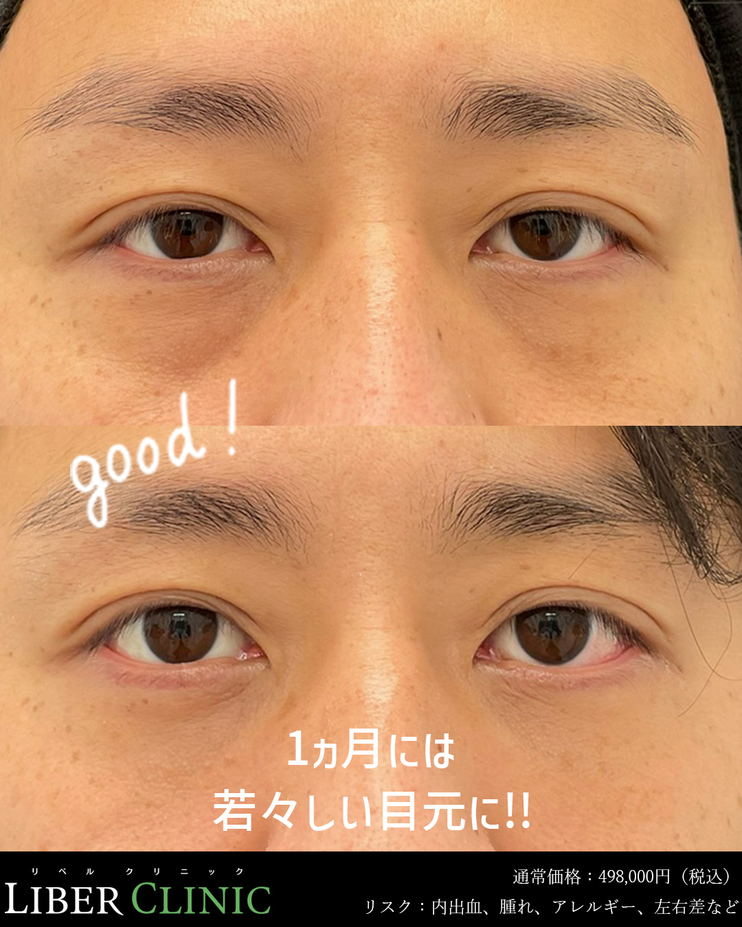 1ヵ月には若々しい目元に！