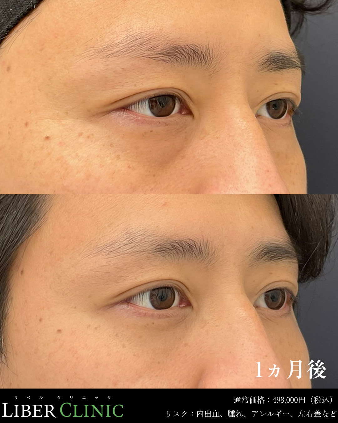 手術前と術後1ヵ月