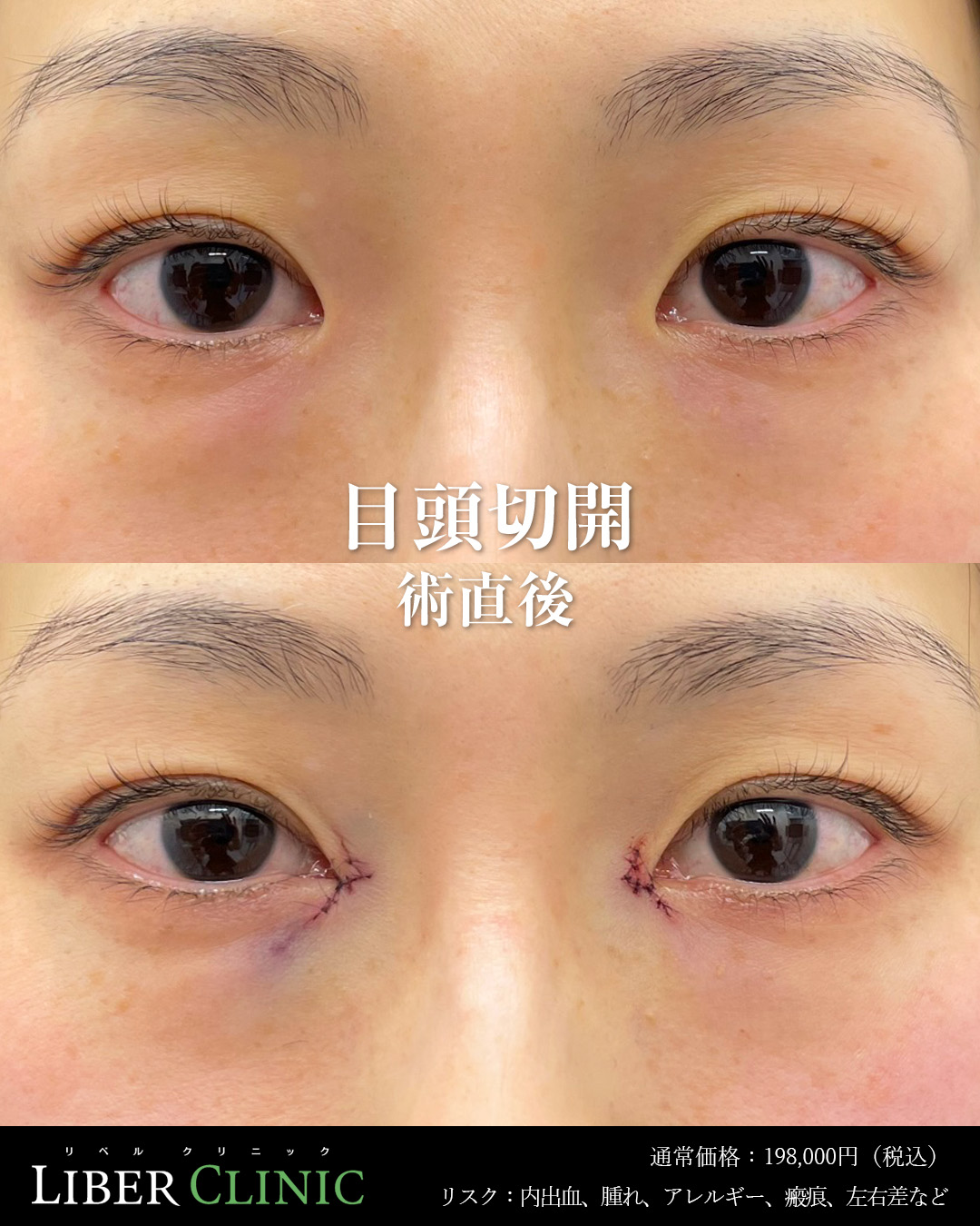 手術前と術直後