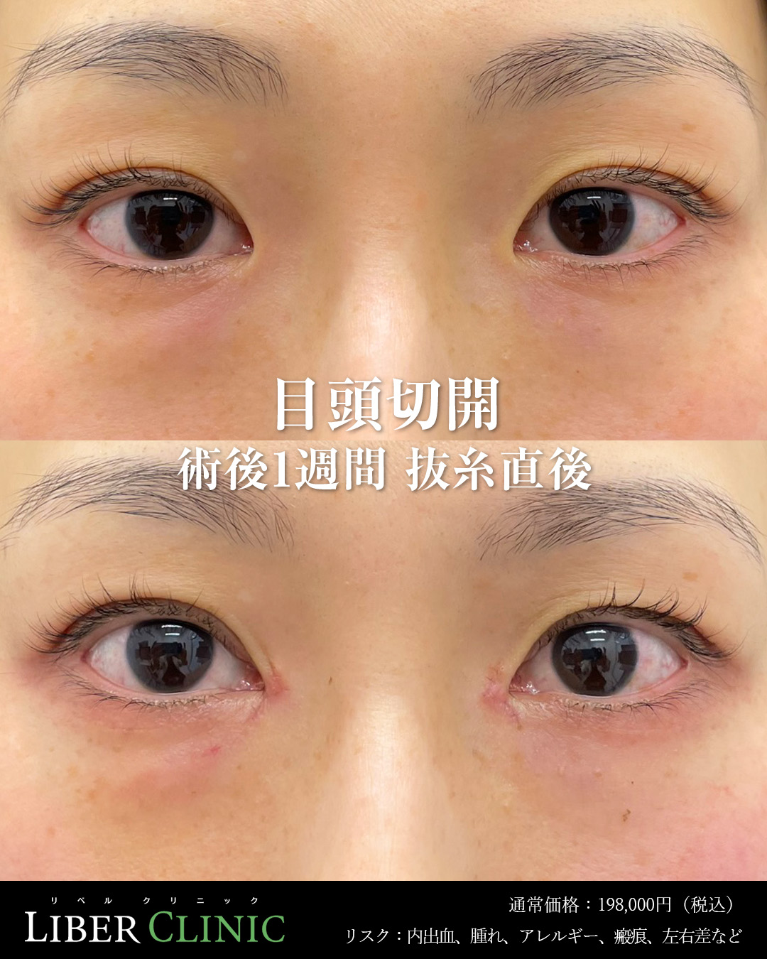 手術前と術後1週間抜糸直後