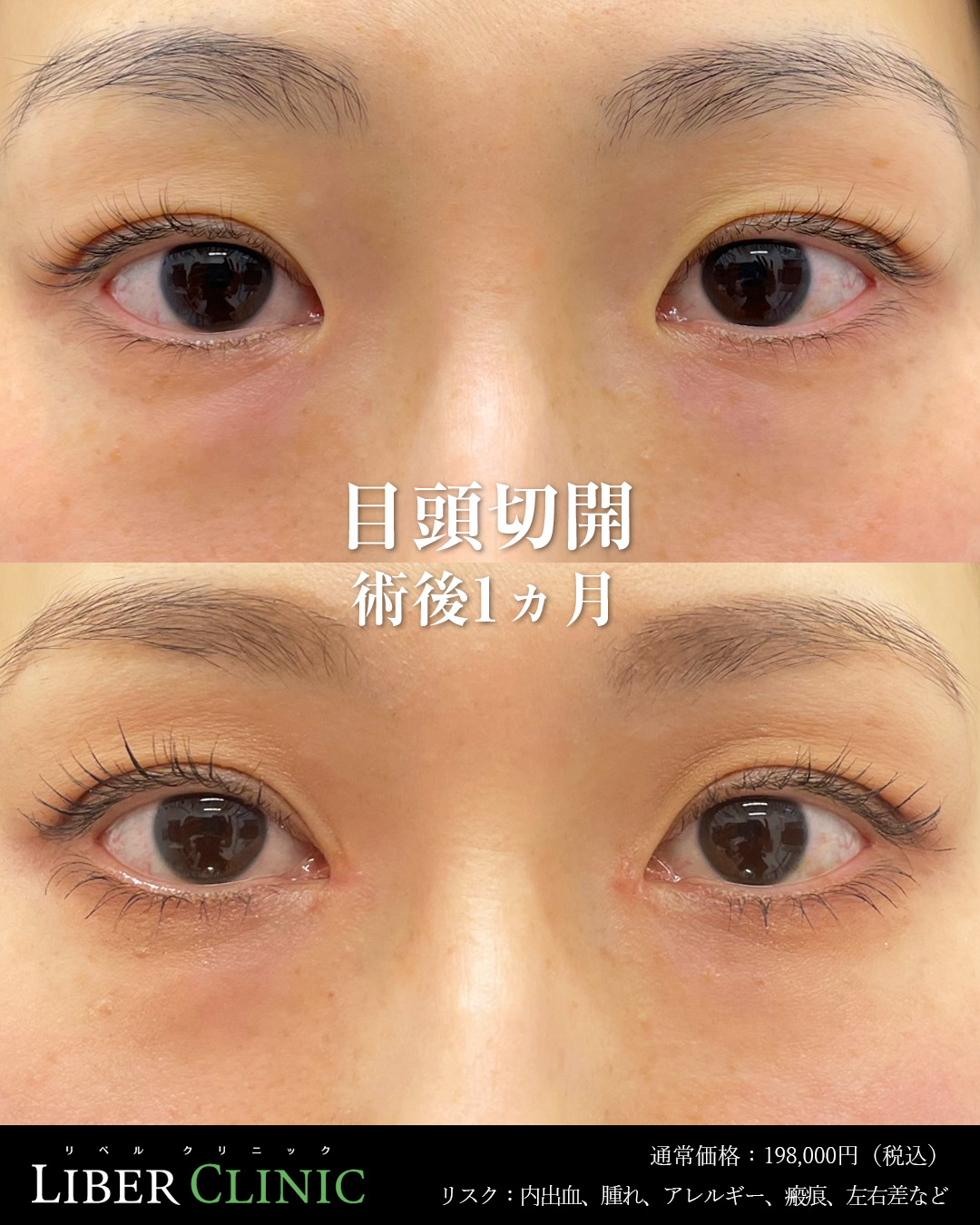 手術前と術後1ヵ月
