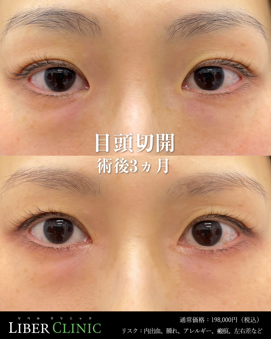手術前と術後3ヵ月