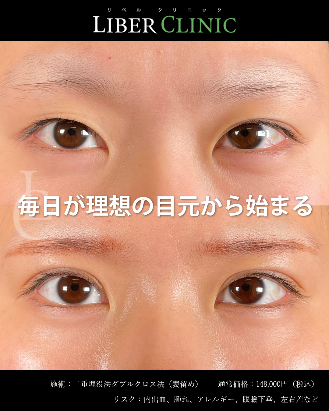 毎日が理想の目元から始まる二重埋没法