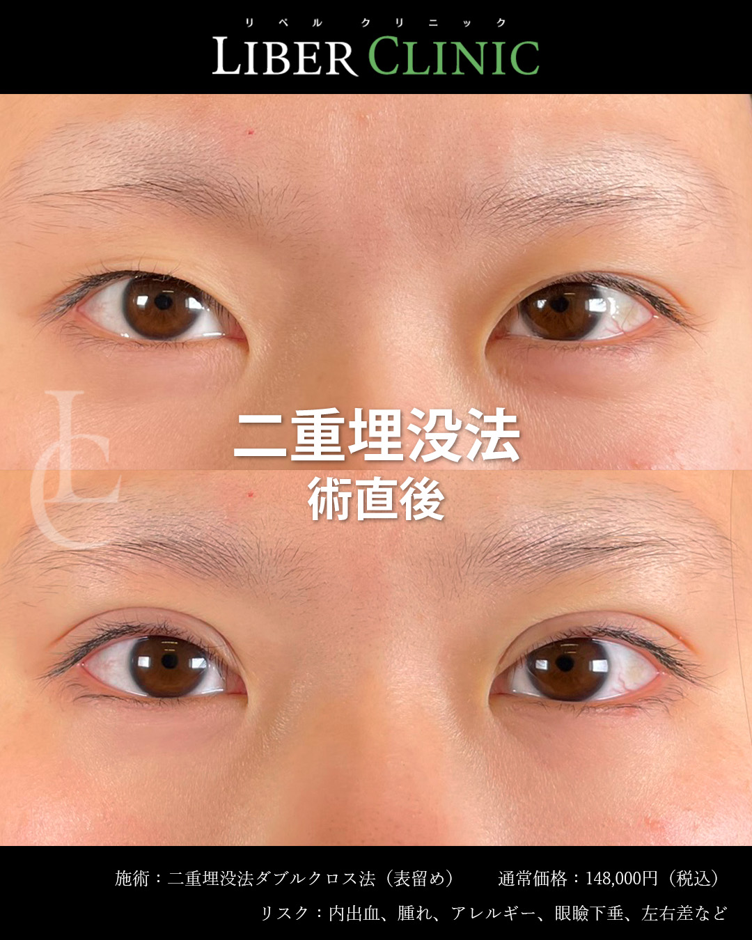 手術前と術直後