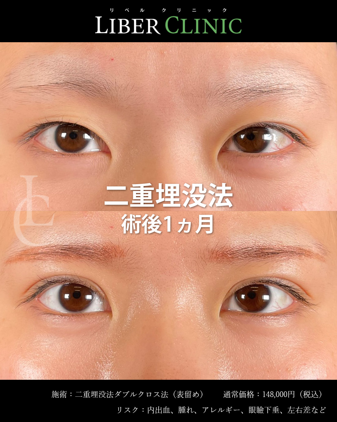 手術前と術後1ヵ月