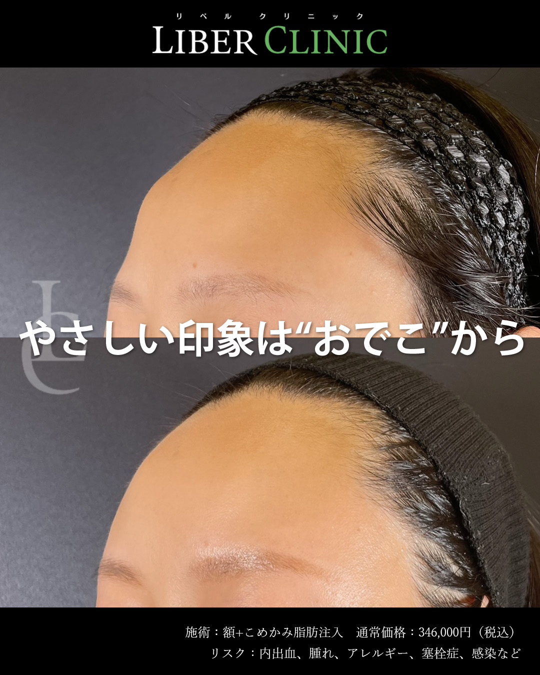 やさしい印象はおでこから