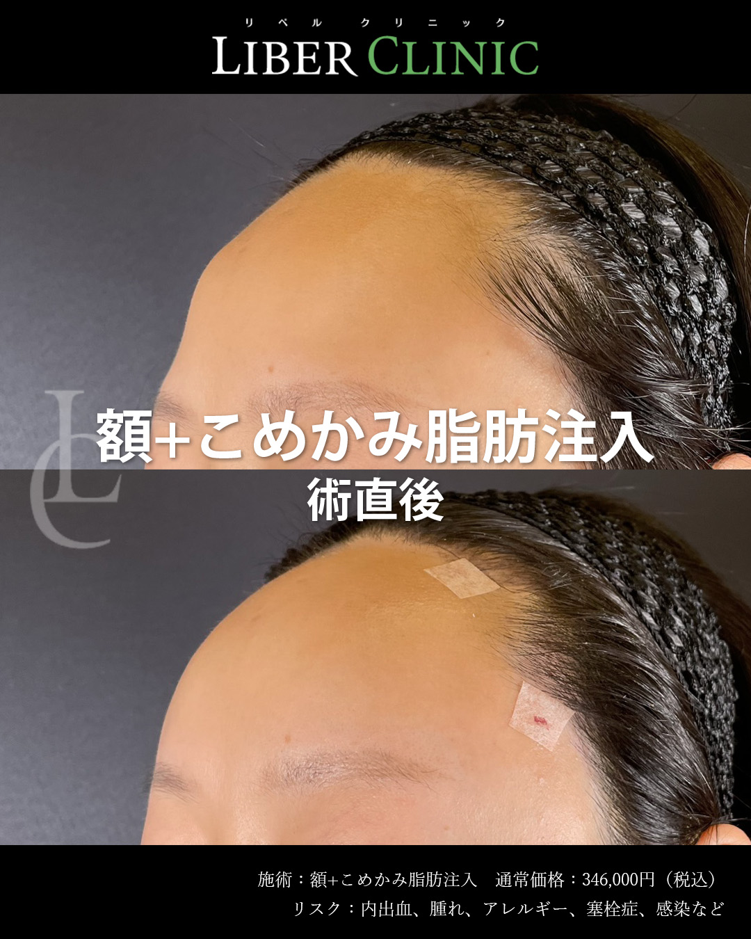 手術前と術直後
