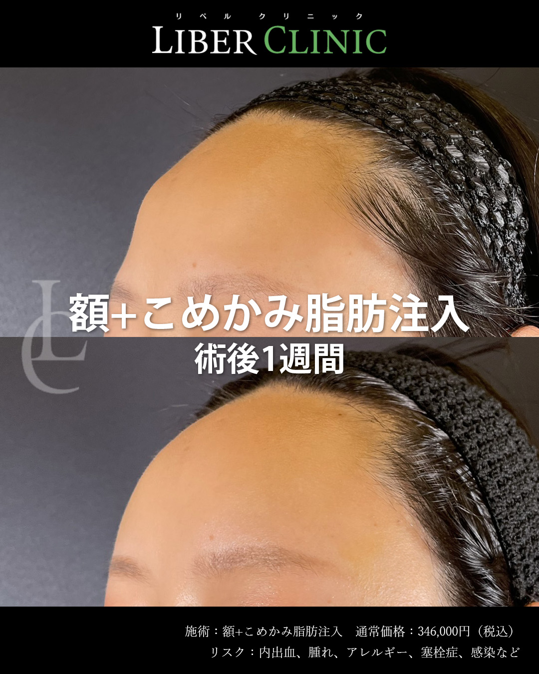 手術前と術後1週間
