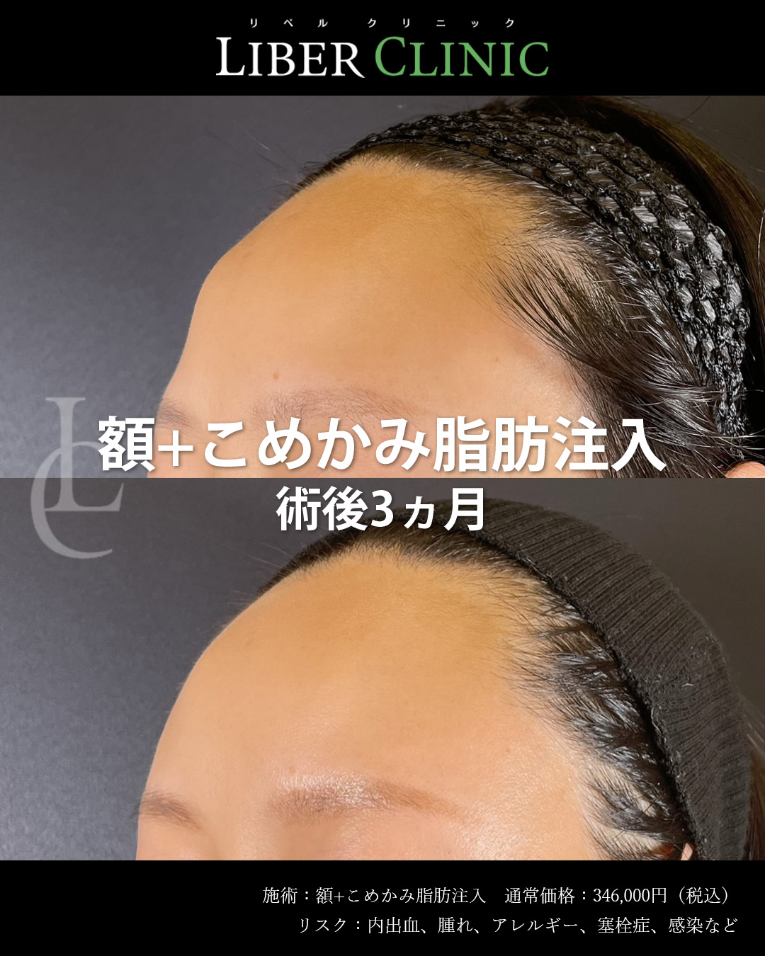 手術前と術後3ヵ月
