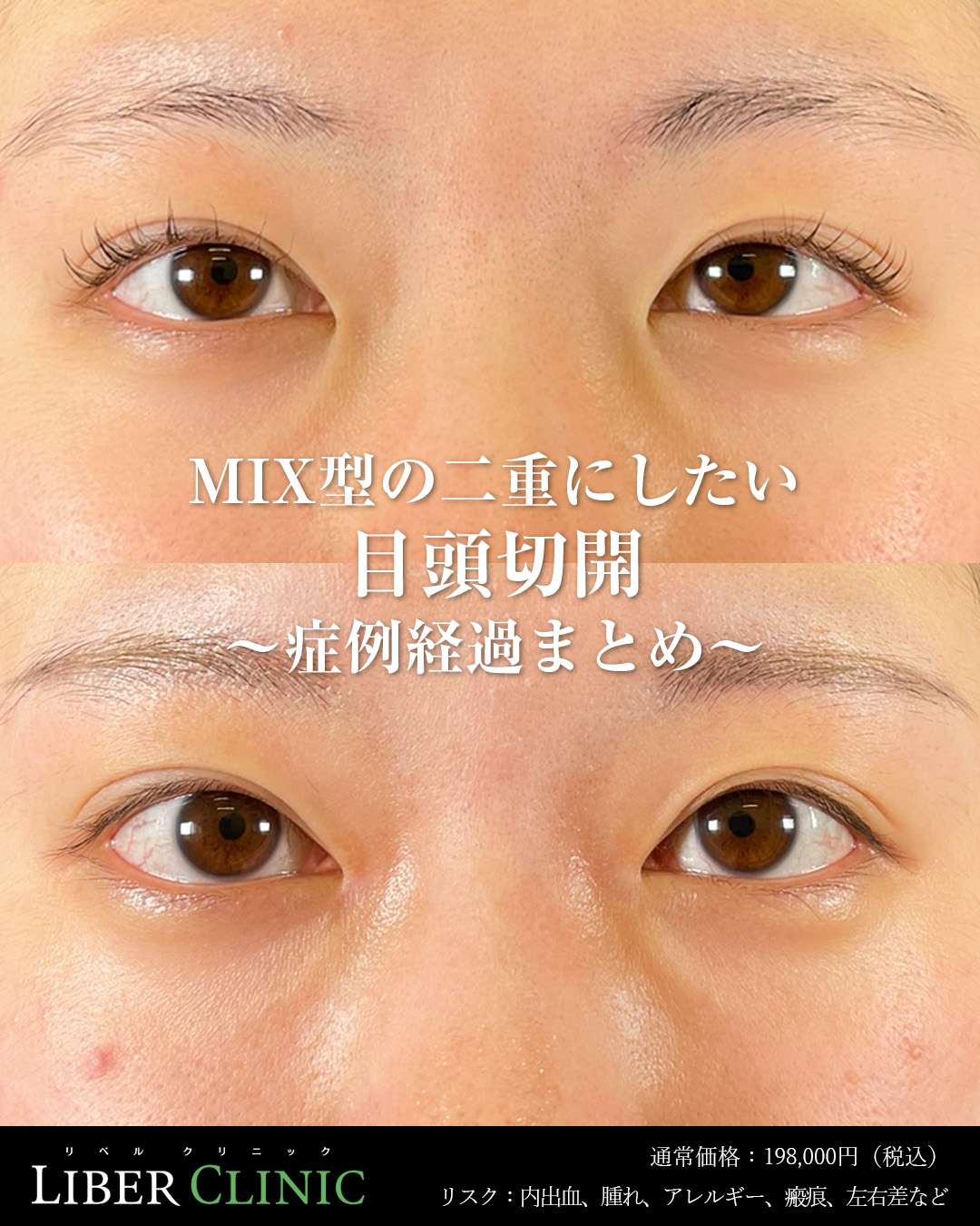 MIX型の二重にしたい目頭切開