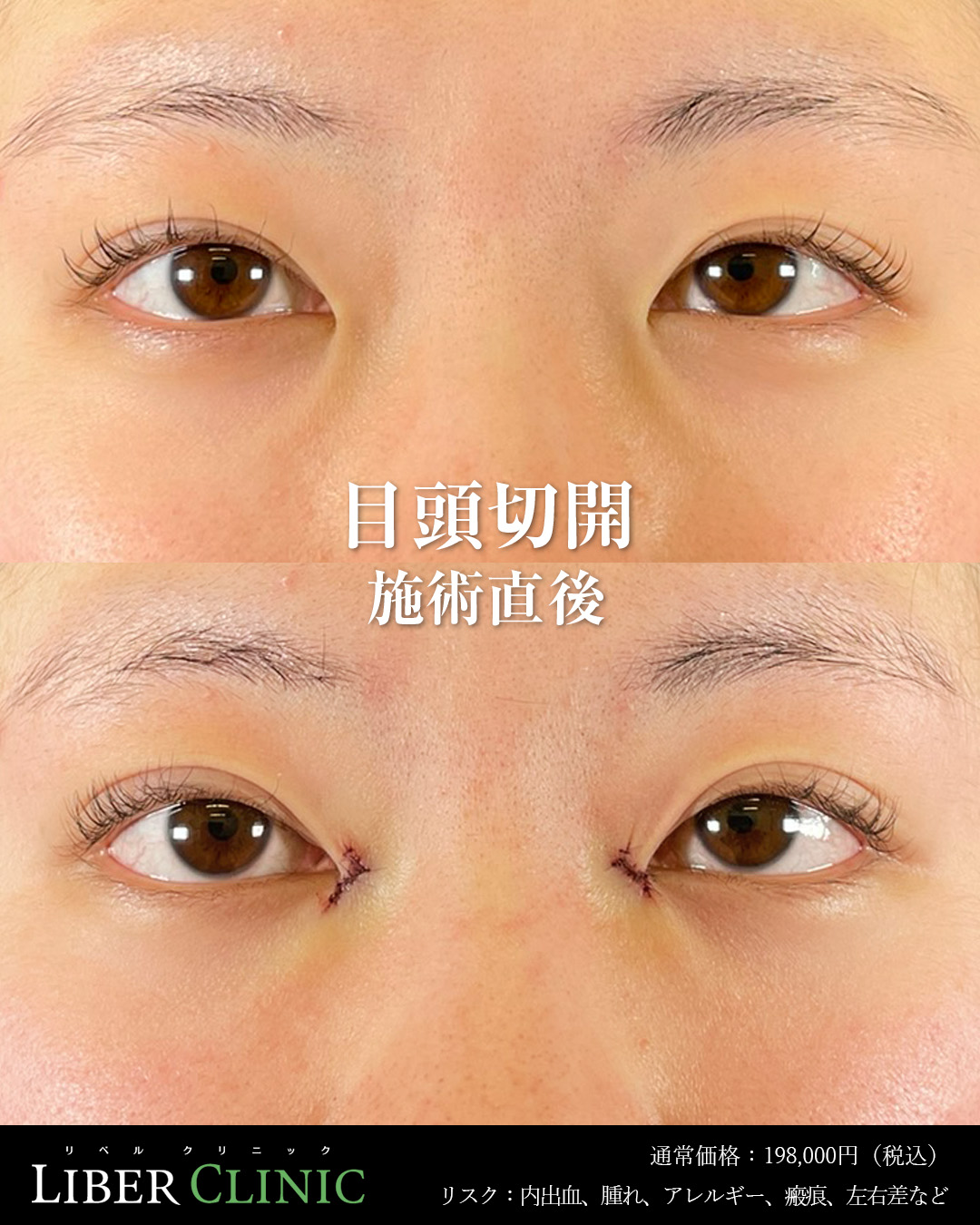 手術前と術直後