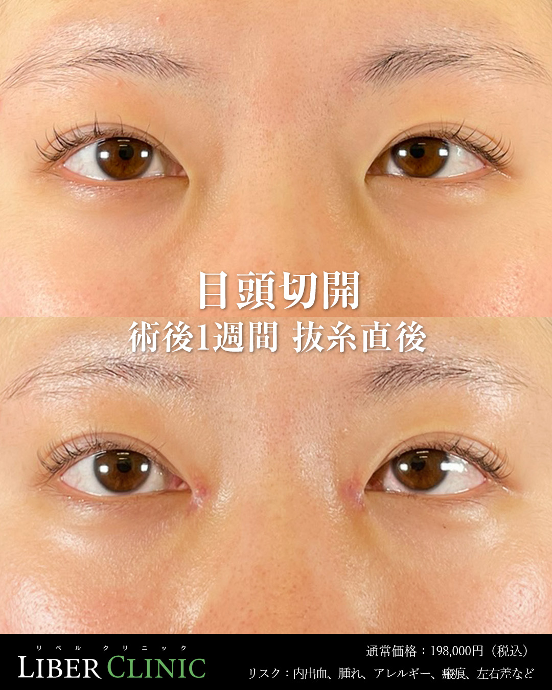 手術前と術後1週間抜糸直後