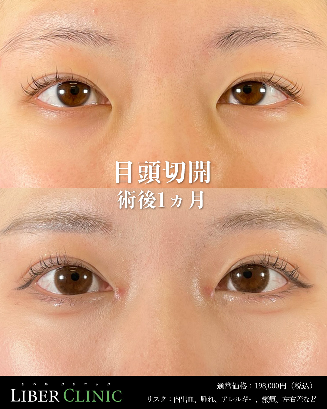 手術前と術後1ヵ月