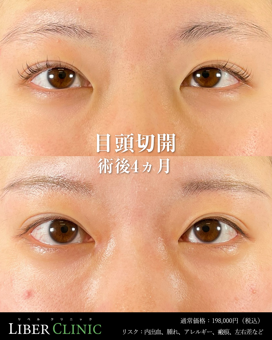 手術前と術後4ヵ月