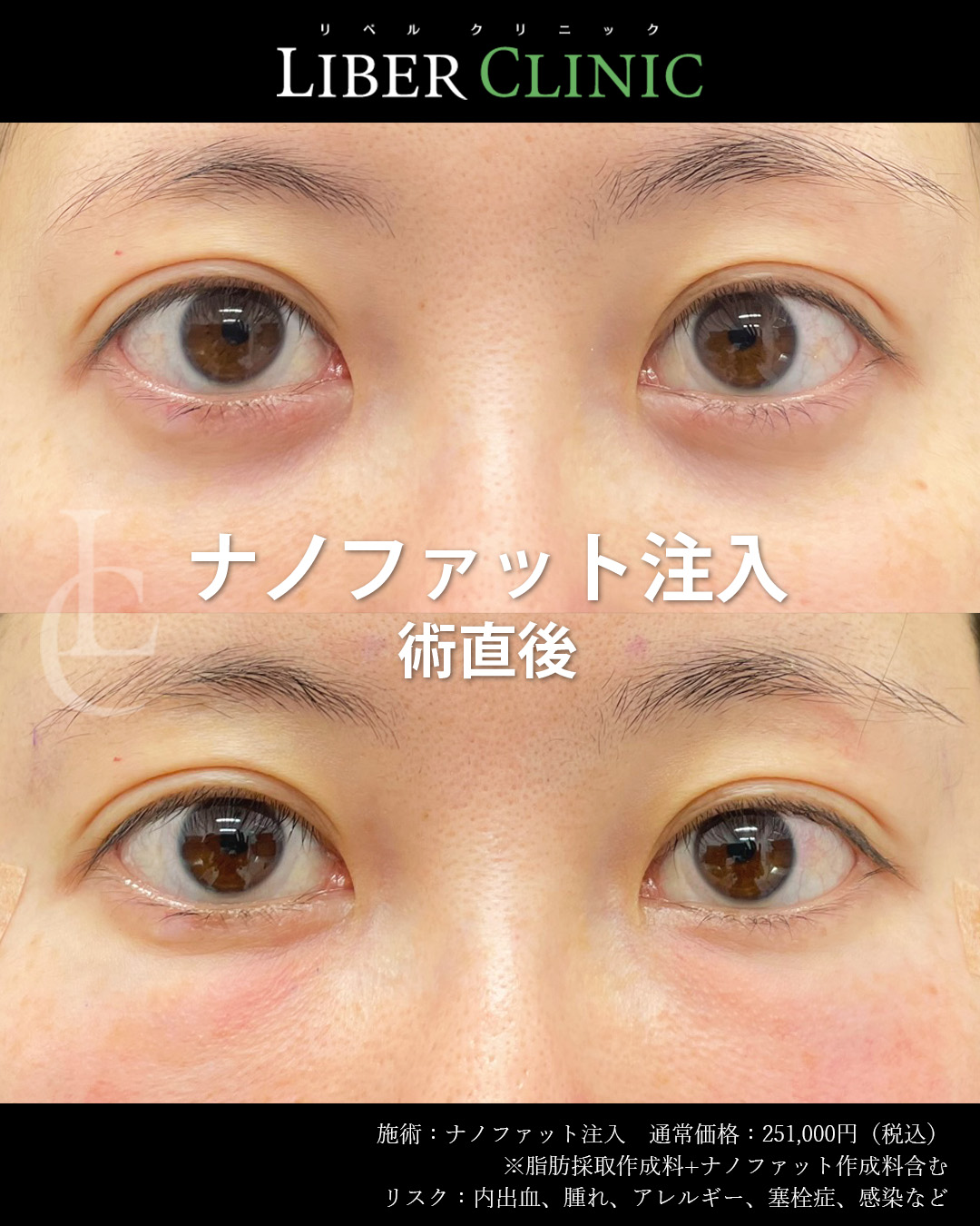 手術前と術直後