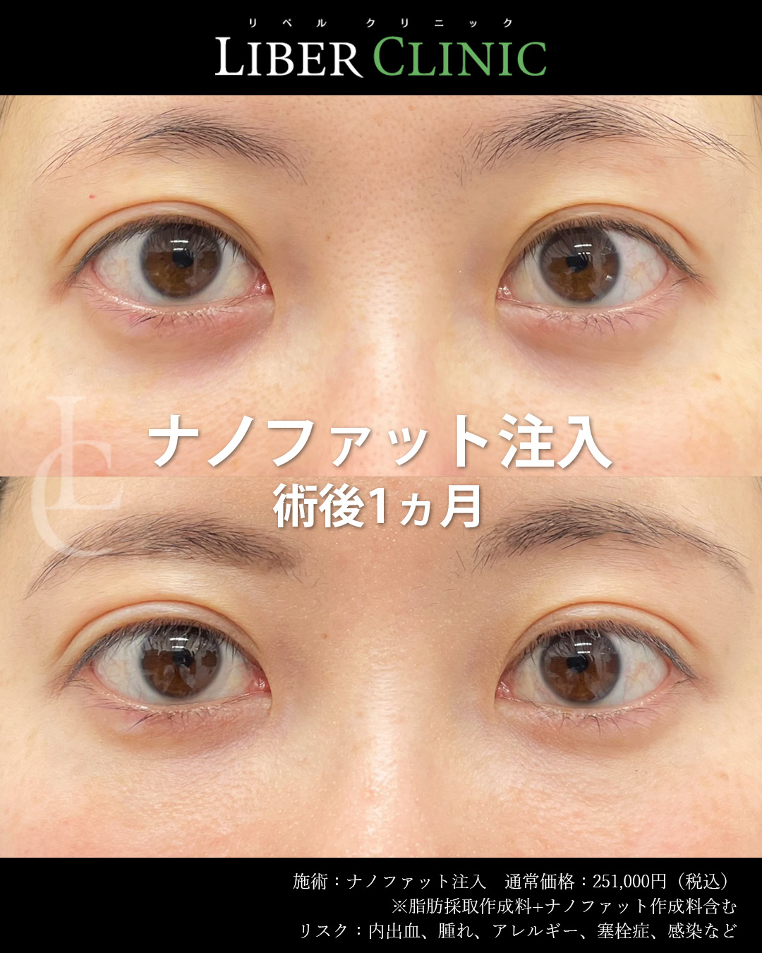 手術前と術後1ヵ月