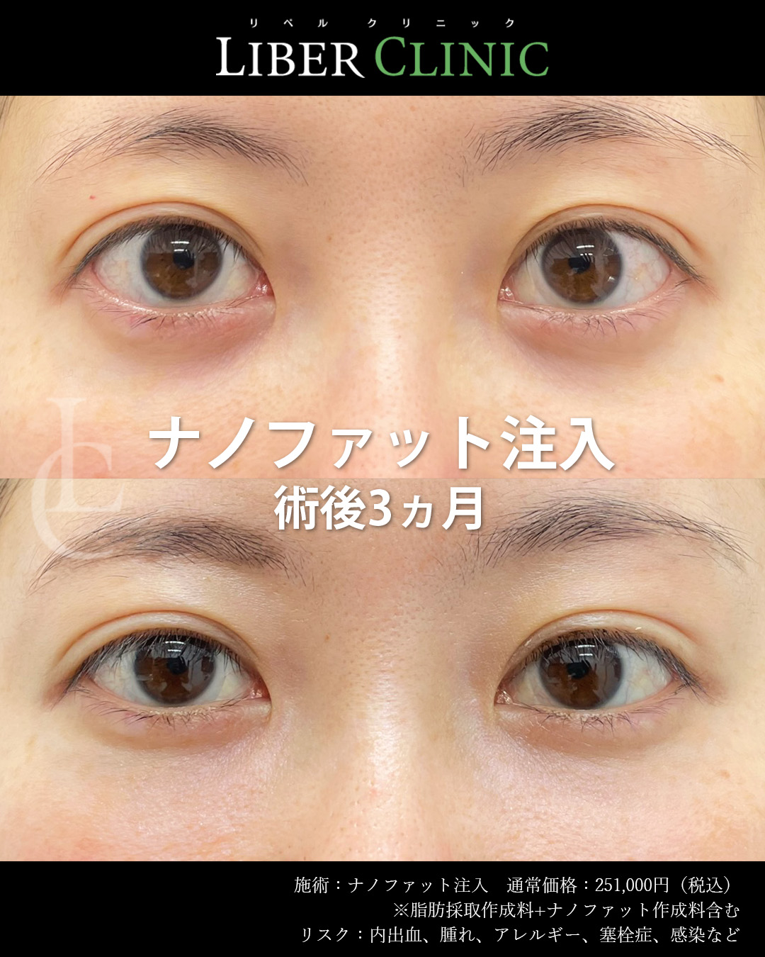 手術前と術後3ヵ月
