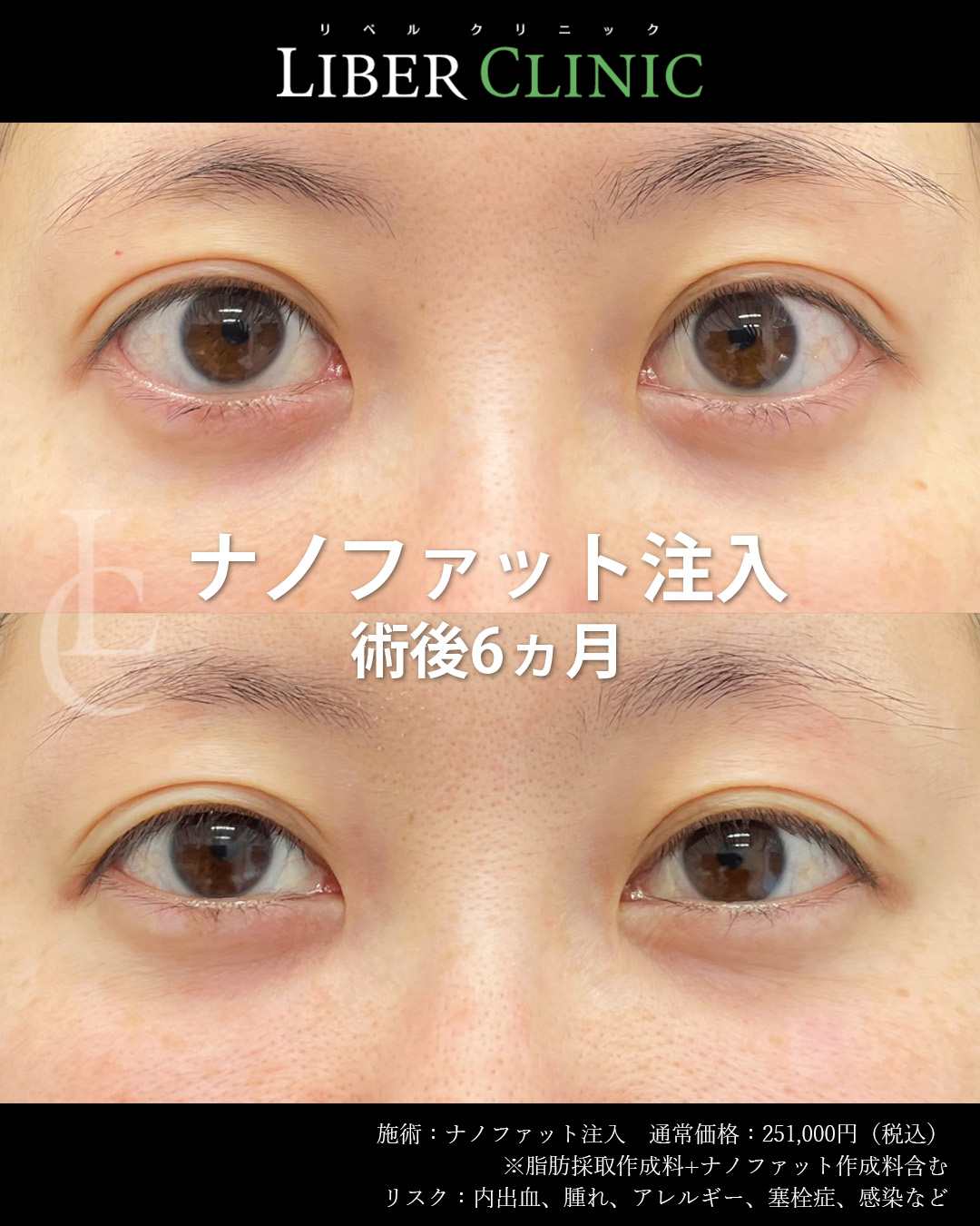 手術前と術後6ヵ月