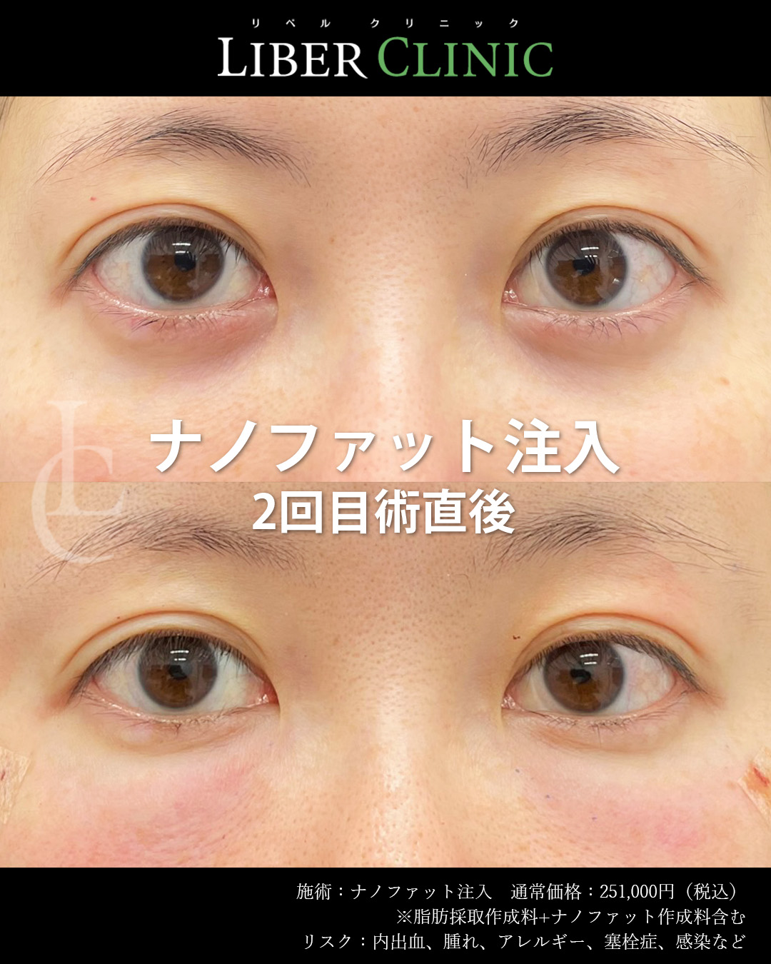2回目｜手術前と術直後