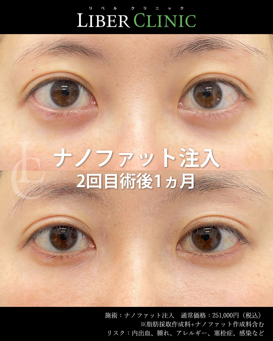 2回目｜手術前と術後1ヵ月