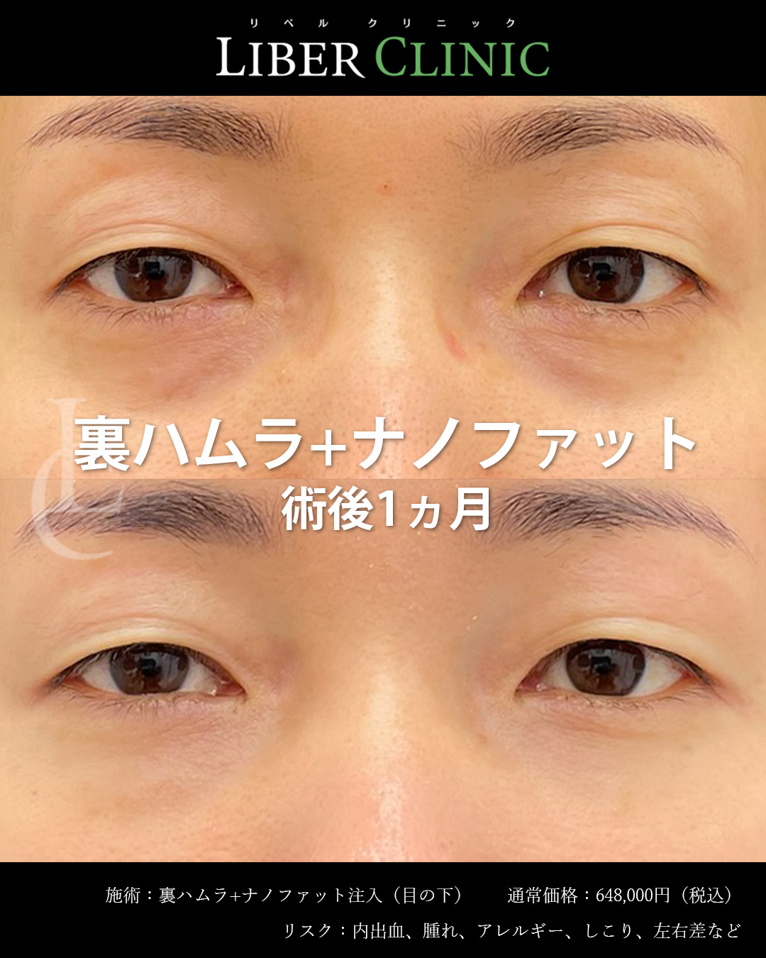 手術前と術後1ヵ月