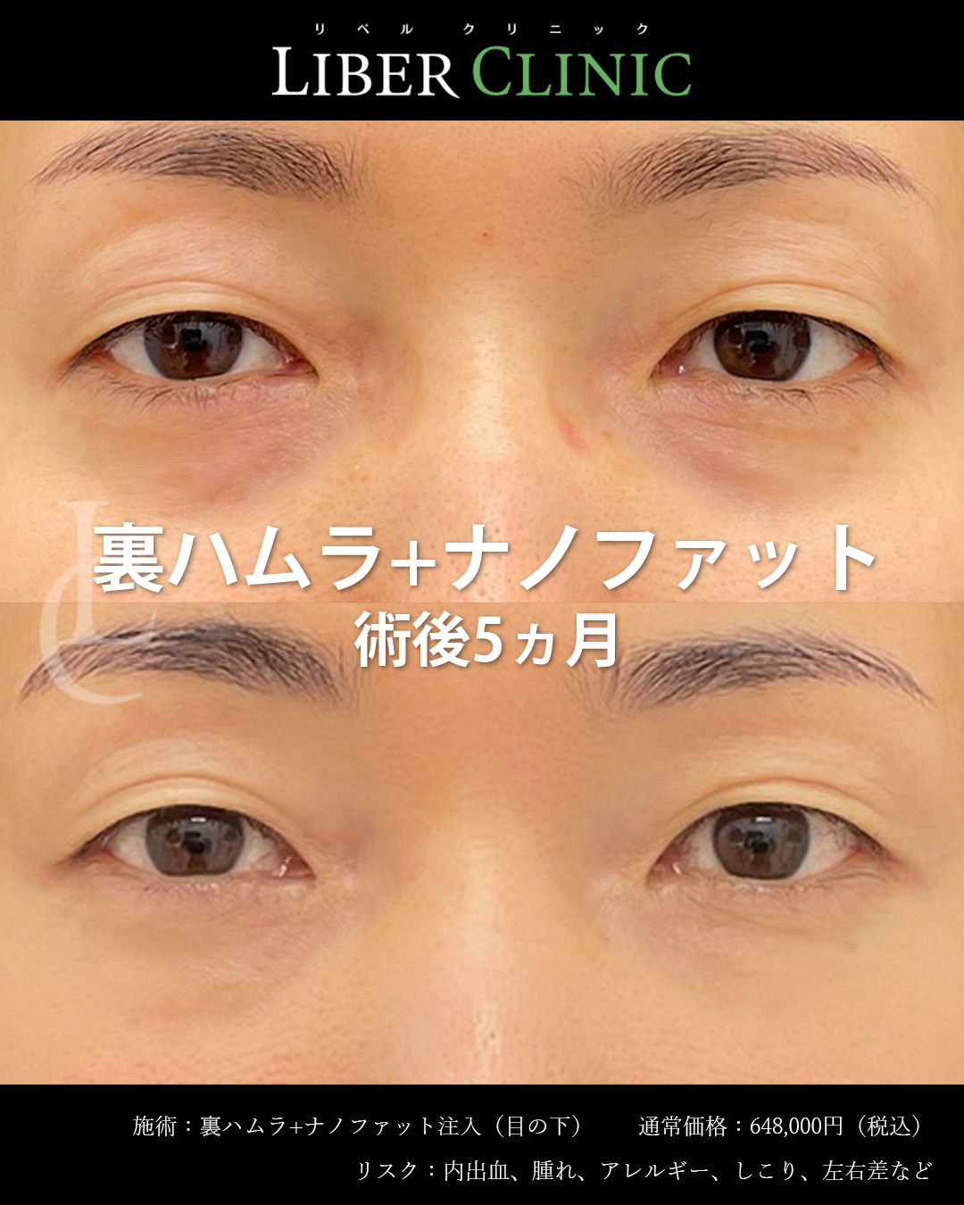 手術前と術後5ヵ月