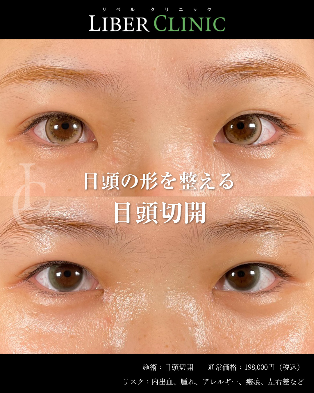 目頭の形を整える目頭切開